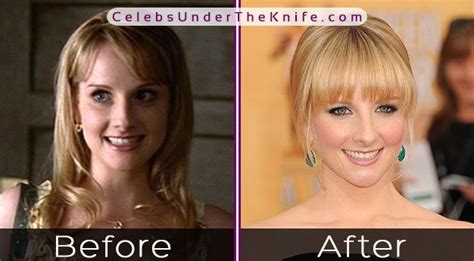 Melissa Rauch Breast Implants and Reductions